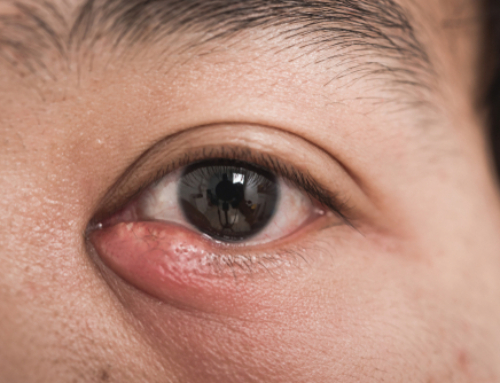 Styes: What Are They and When Should You Be Concerned?