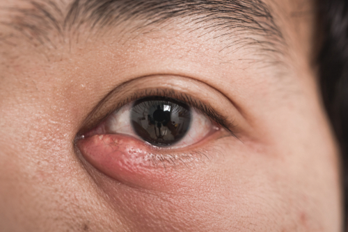 Swollen Eyes And Eyelids: Why And How To Treat Them