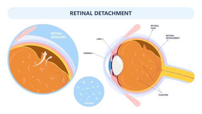 detached retina warning signs
