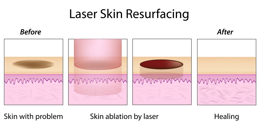 laser skin resurfacing flei