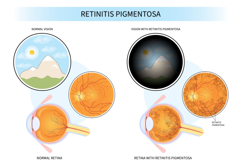 retinitis pigmentosa image