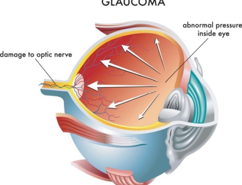 What is a glaucoma suspect?