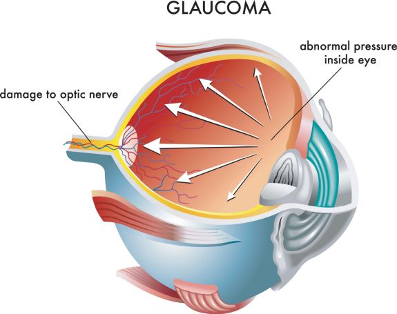 abnormal pressure inside eye glaucoma