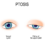 Overview of Ptosis Causes and Treatment