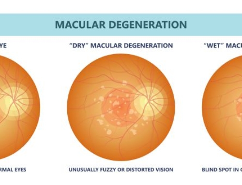Wet vs Dry Macular Degeneration