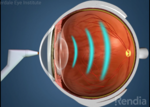 A-Scan Biometry for Cataracts
