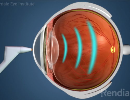 Cataracts: A-Scan Biometry