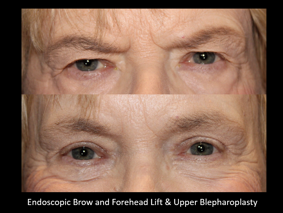 endoscopic brow, forehead lift, and blepharoplasty before and after
