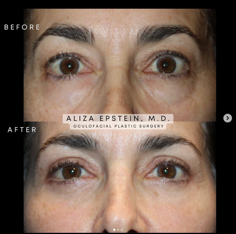 CO2 Laser for Under Eyes before and after