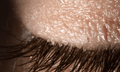 Understanding Demodex Mites And Blepharitis Causes