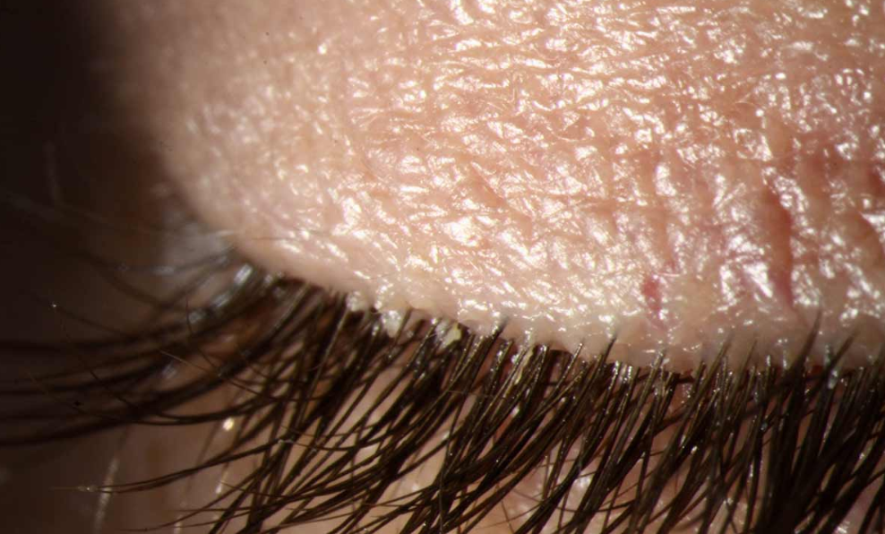 Demodex-Mites-and-Blepharitis-on-Eyelashes