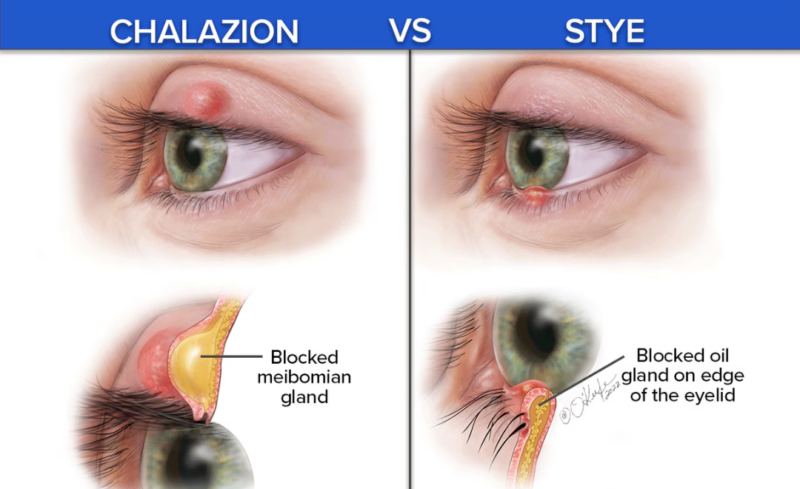 Difference Between Stye And Chalazion Explained Clearly 