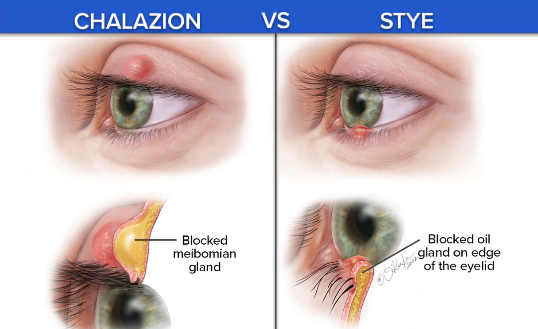 the difference between a stye and chalazion 2 Chalazion vs. Stye e1770911431147