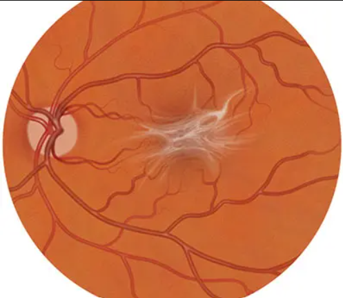 macular pucker