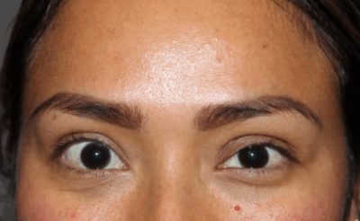 After Chalazion Removal