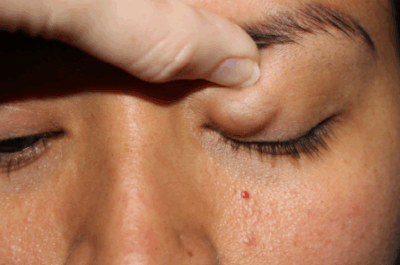 Chalazion on Eyelid