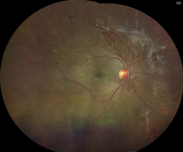 diabetic retinopathy