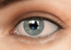 entropion: what is it? 13 eyelid with entropion