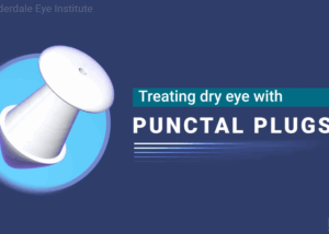 dry eye: treatment - punctal plugs 4 punctal plugs dry eye