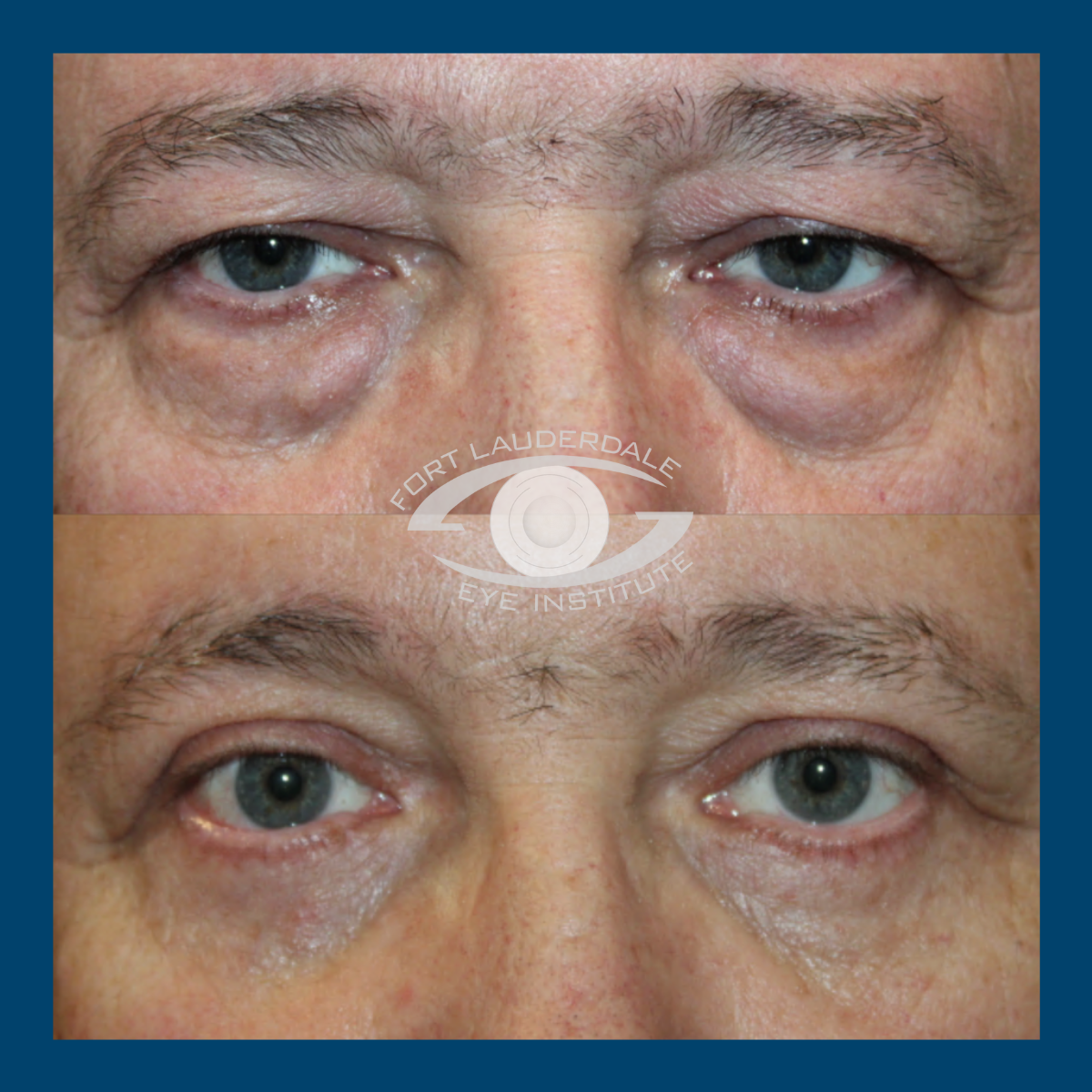 lower blepharoplasty before and after