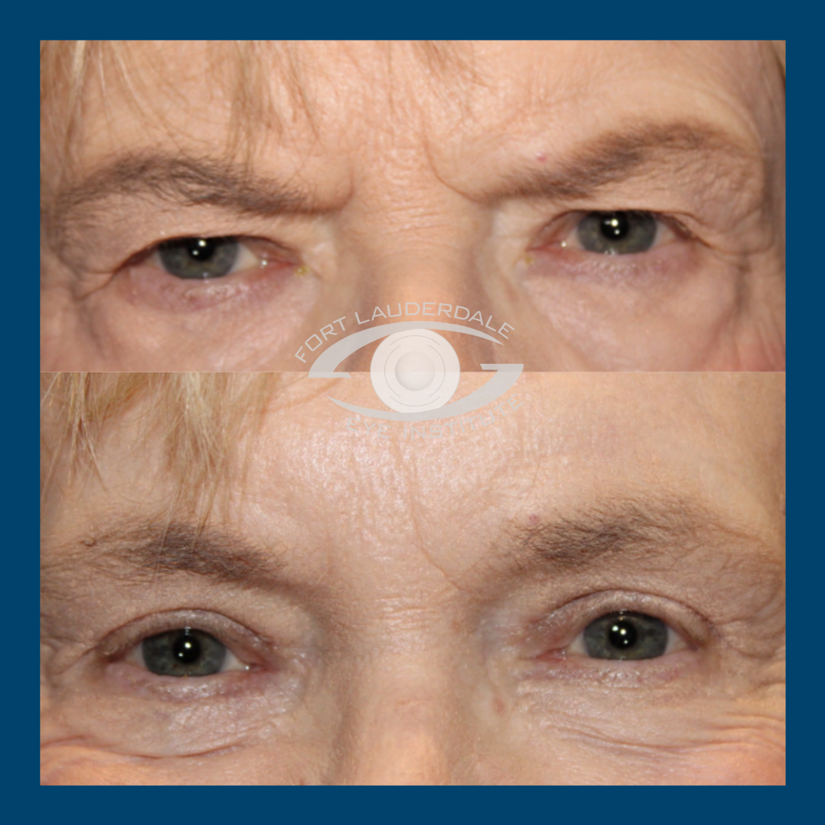 brow lift before and after