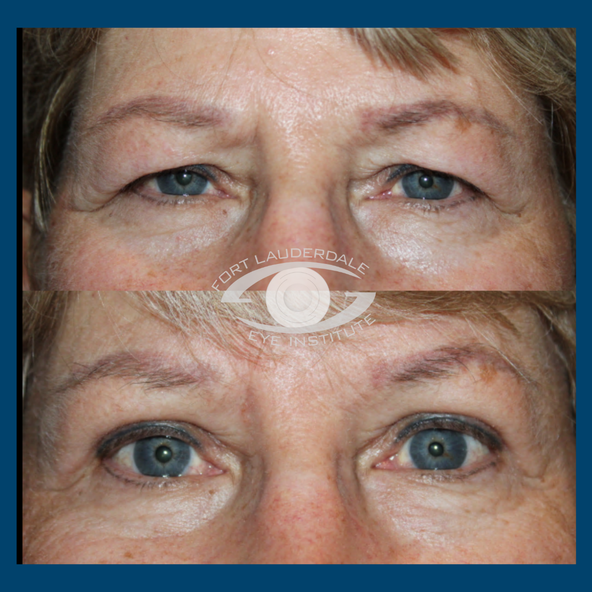 brow lift before and after
