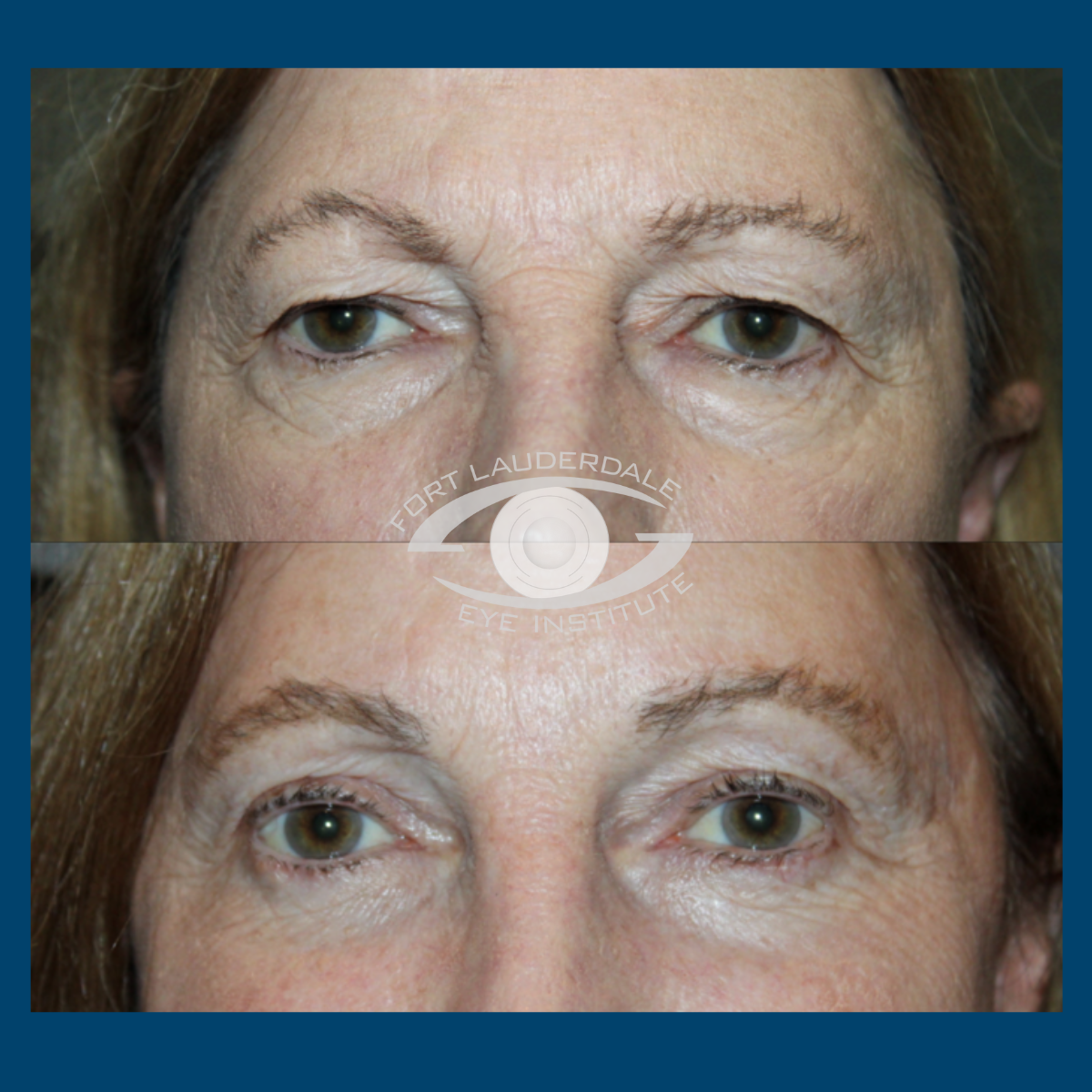 brow lift before and after