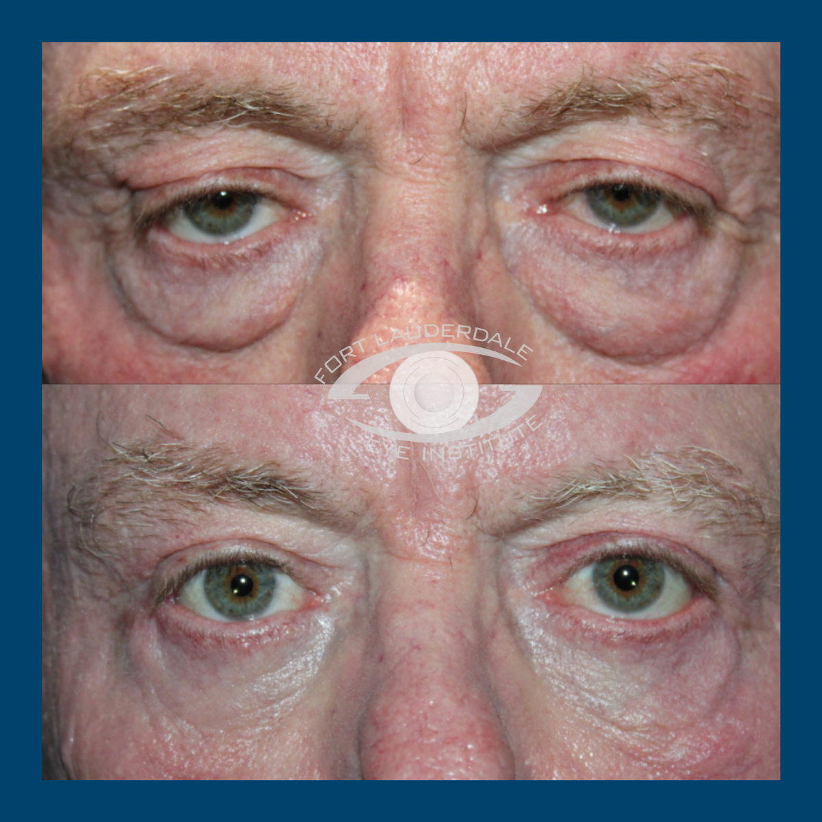 lower blepharoplasty before and after