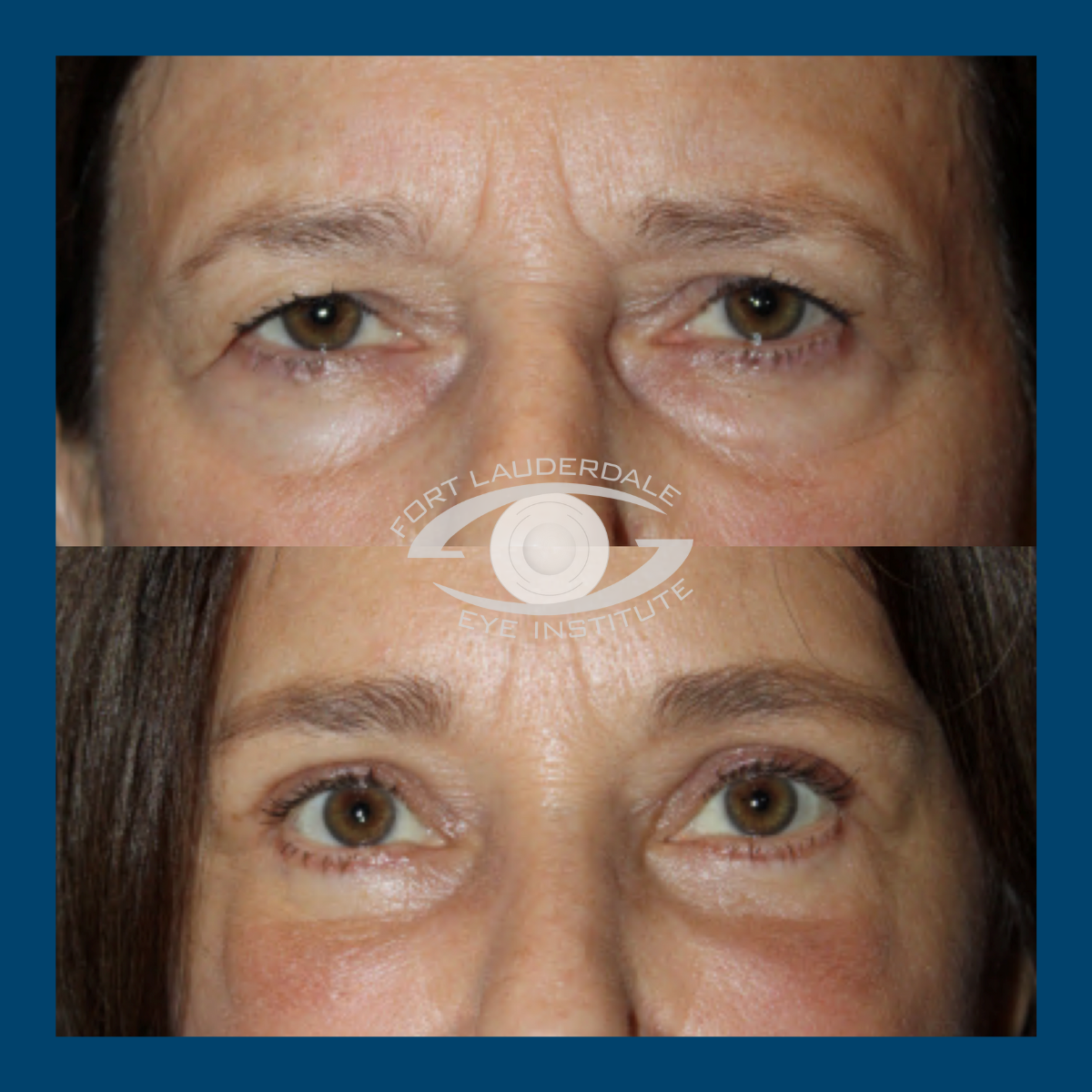 brow lift before and after