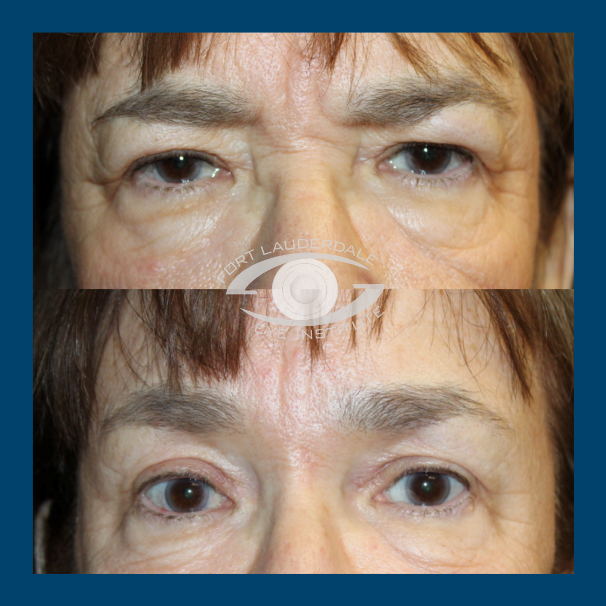 brow lift before and after