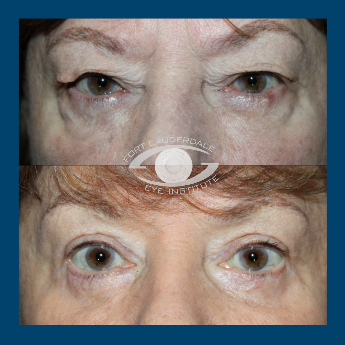 lower blepharoplasty before and after