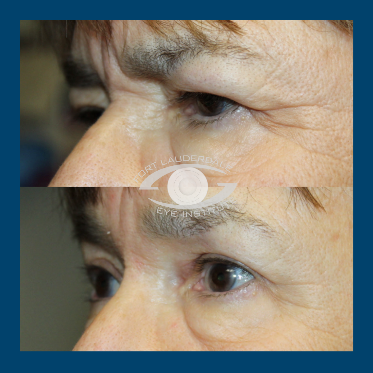 brow lift before and after side view