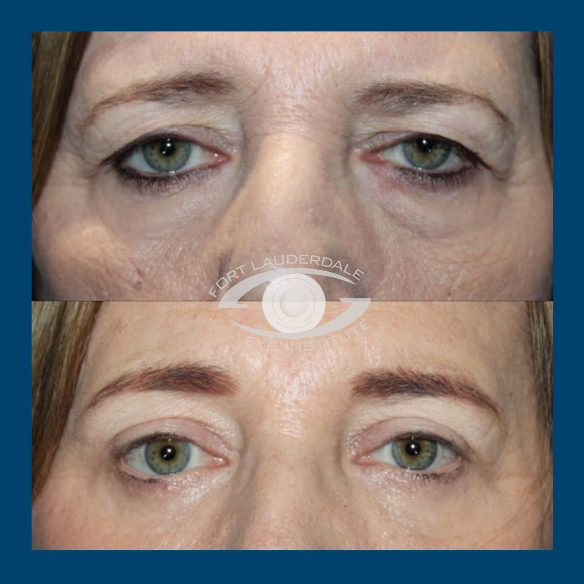 brow lift before and after