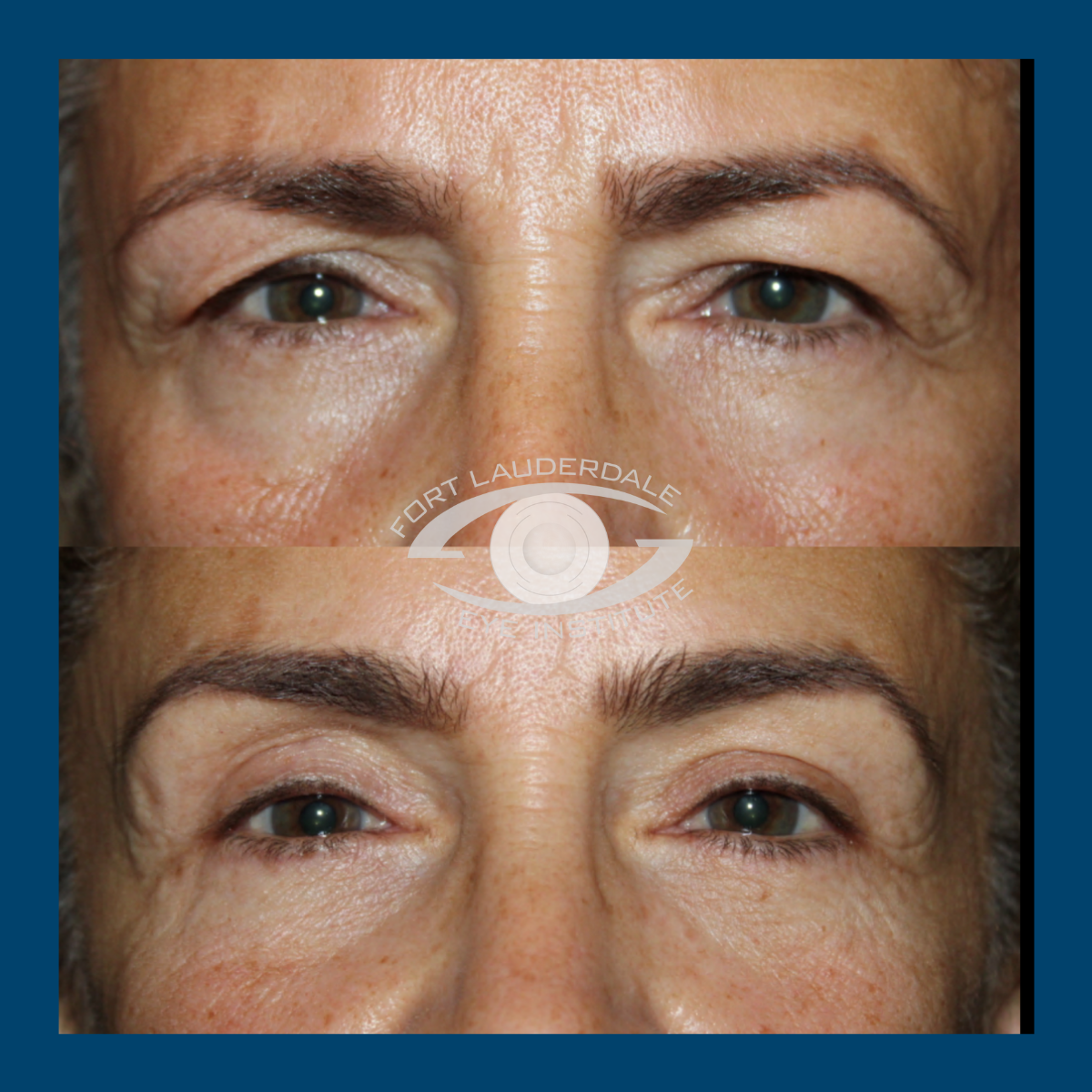 lower blepharoplasty before and after