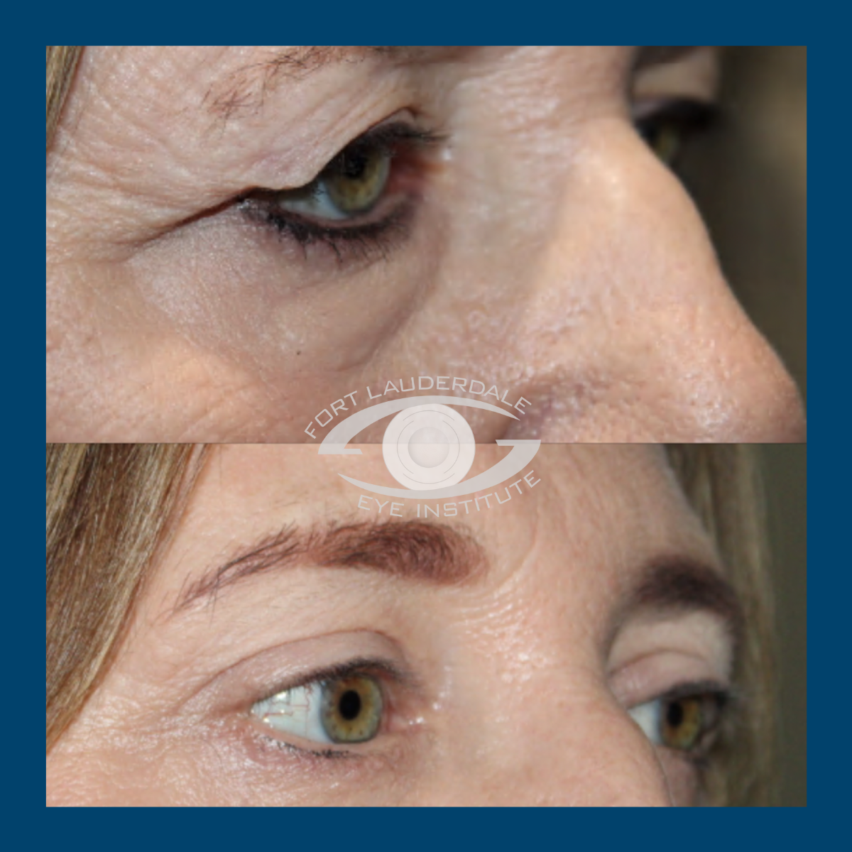 brow lift before and after
