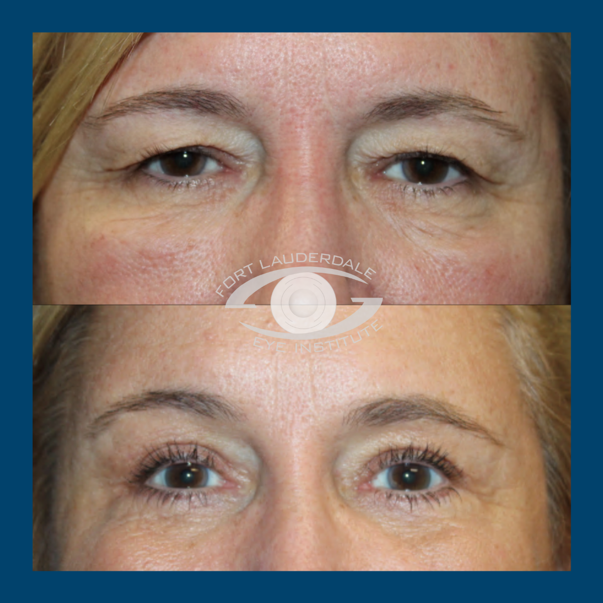 brow lift before and after