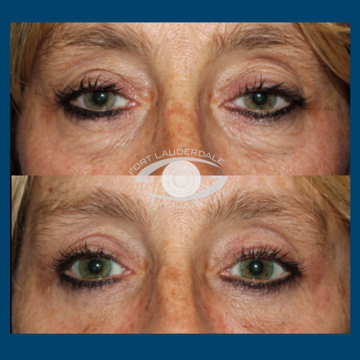 lower blepharoplasty before and after