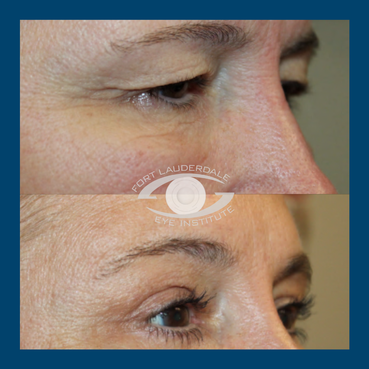 brow lift before and after side view