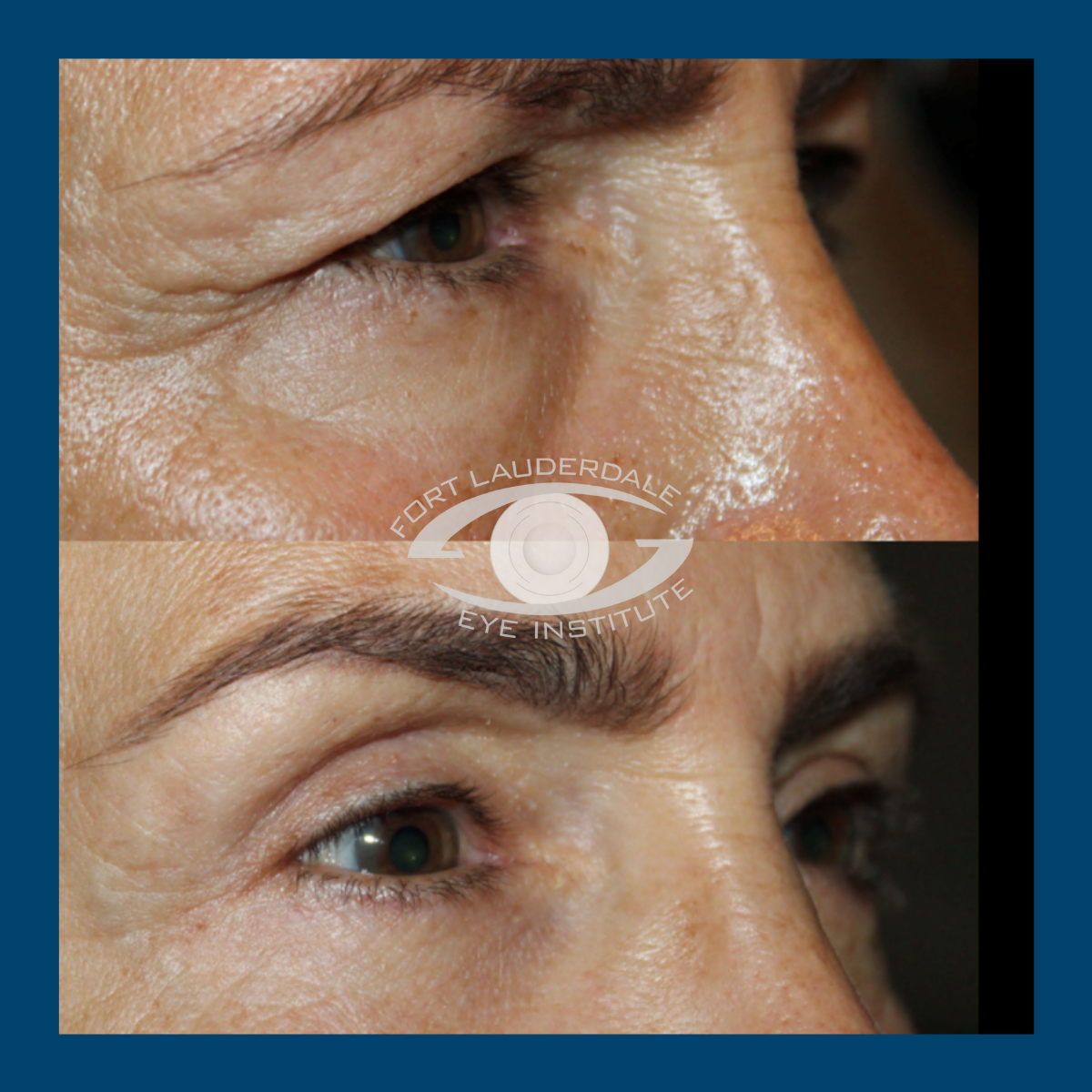 lower blepharoplasty before and after