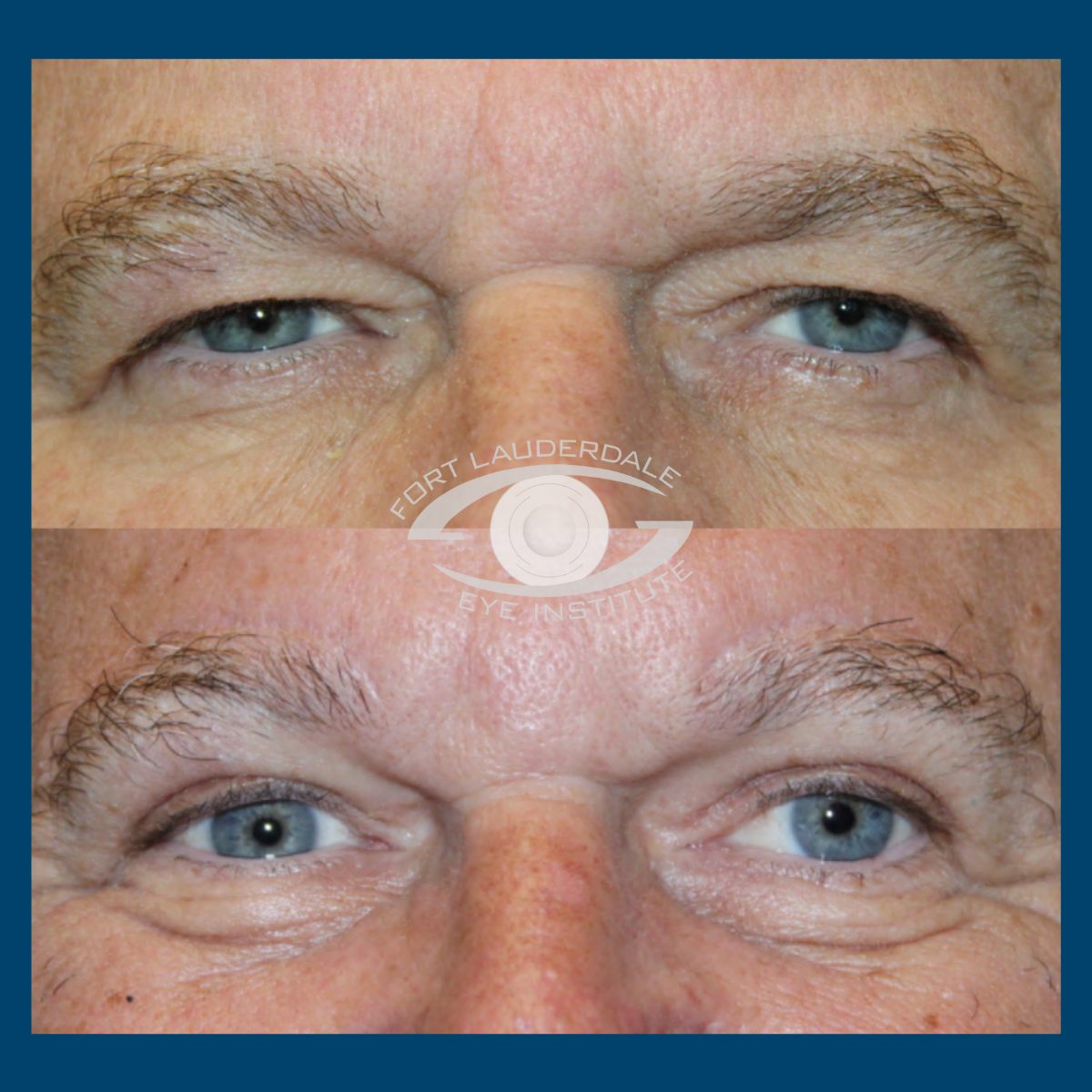 brow lift before and after