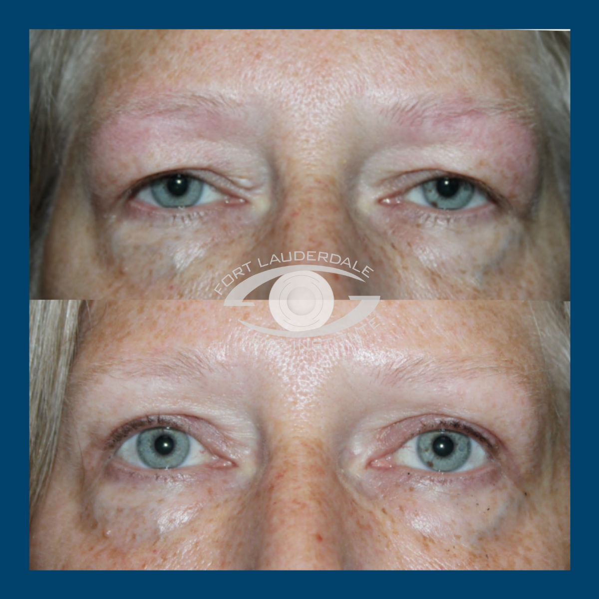 pt 1 upper blepharoplasty 9 2025
