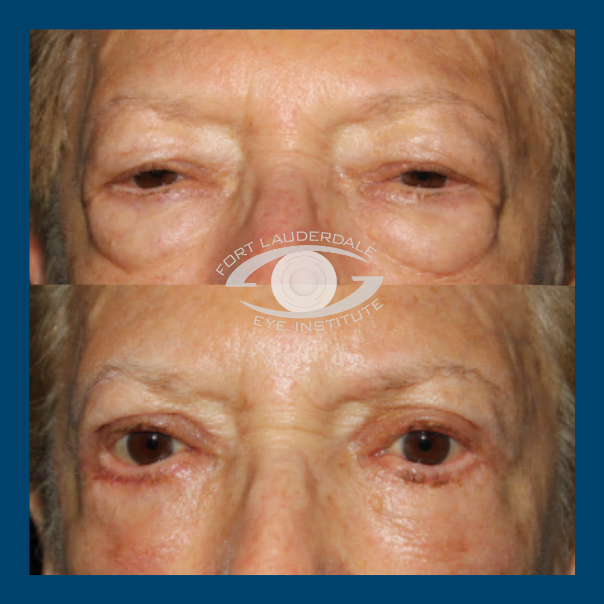 pt1 upper lower bleph