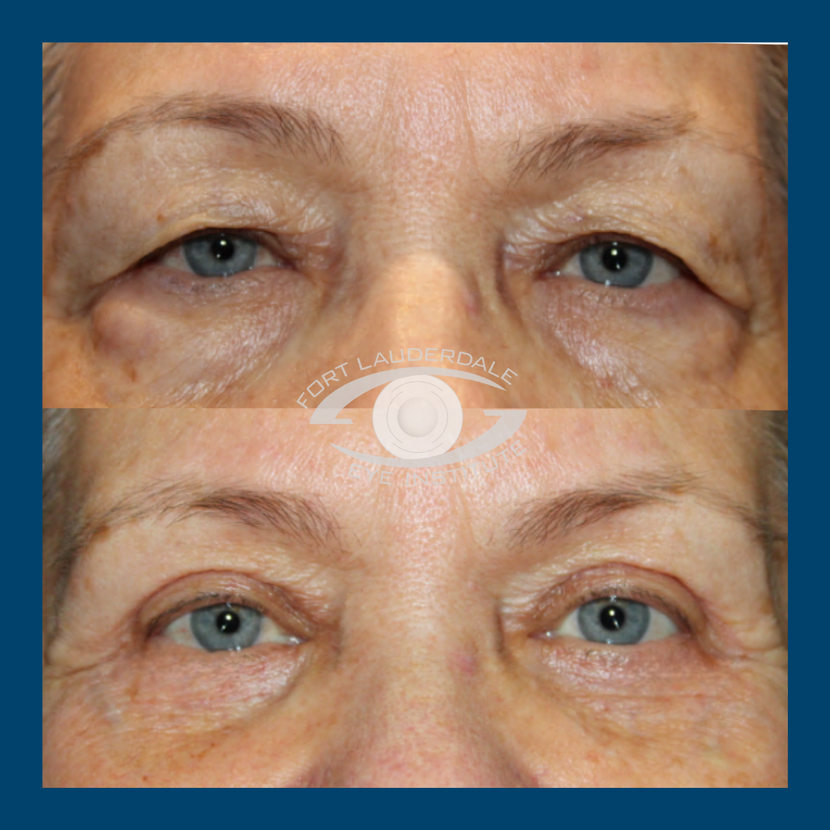 pt10 upper lower bleph