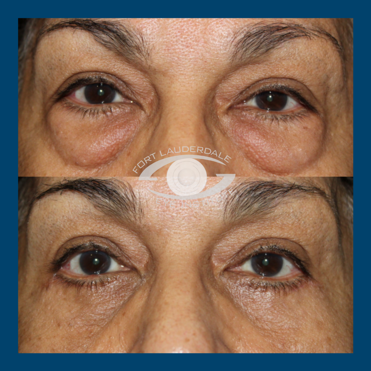 pt11 upper lower bleph