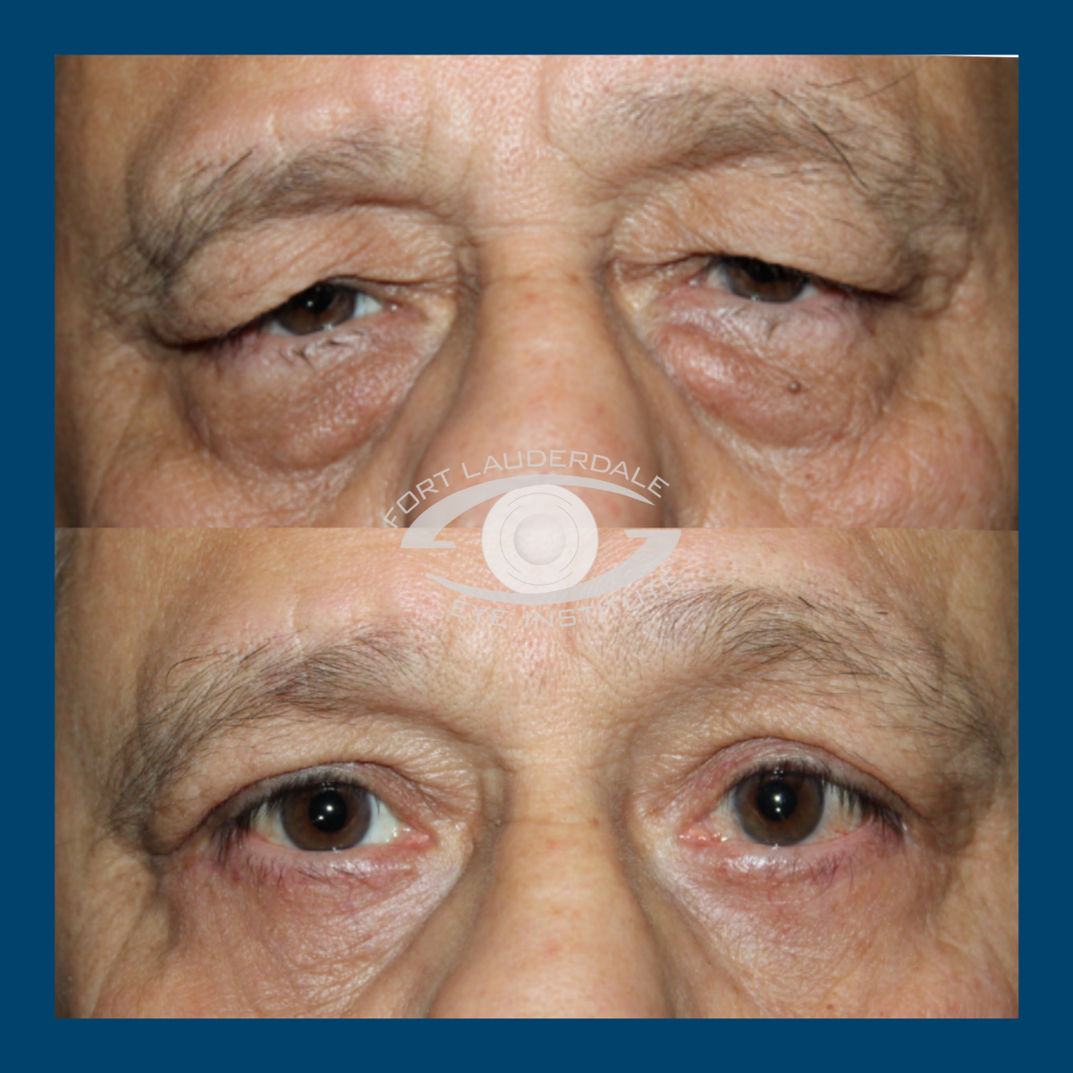 pt12 upper lower bleph