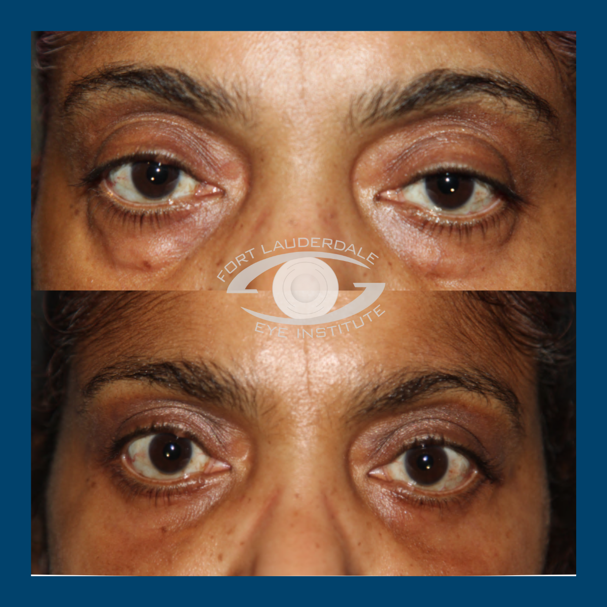 pt2 upper lower bleph