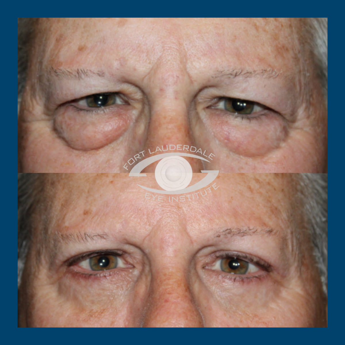 pt3 upper lower bleph