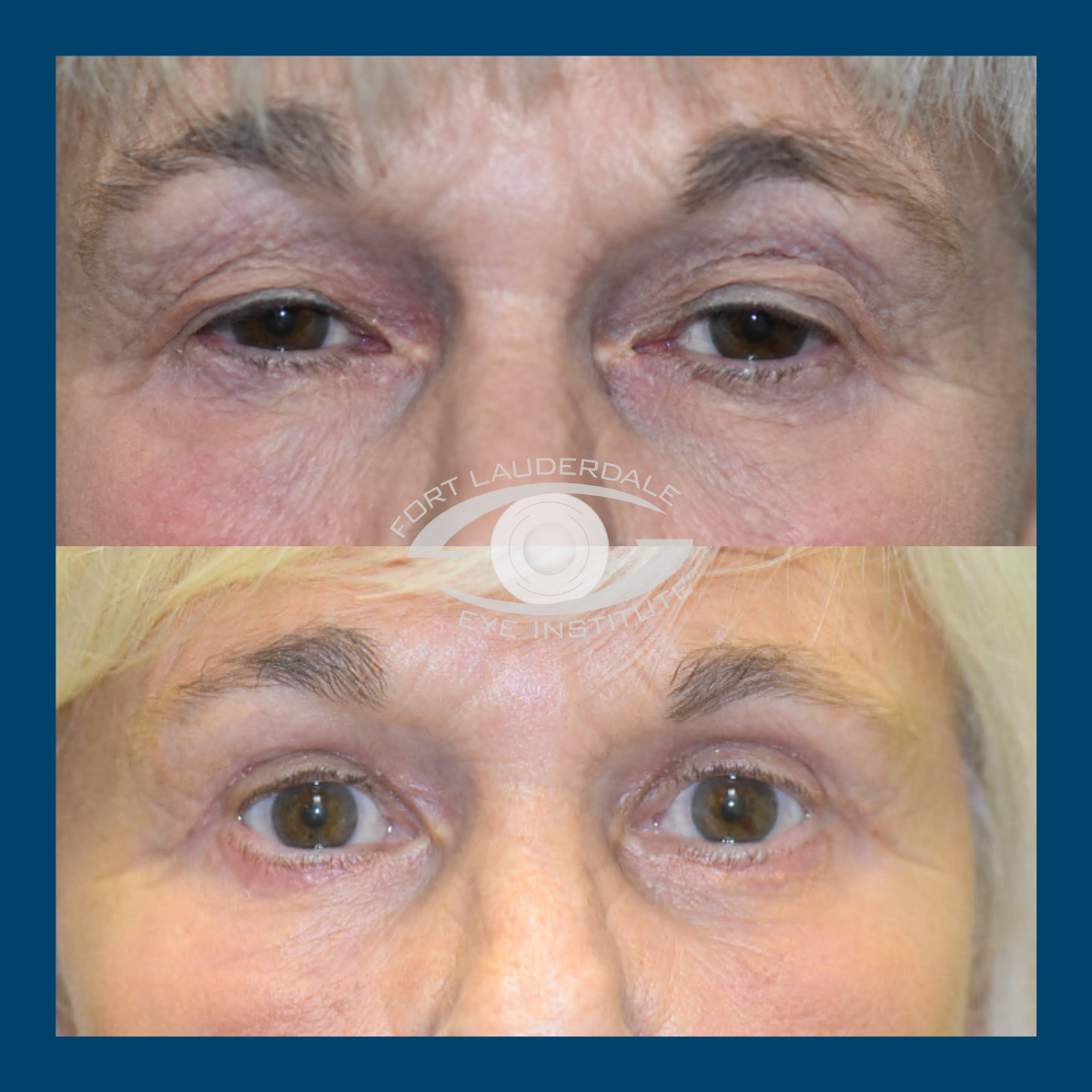 pt4 upper lower bleph