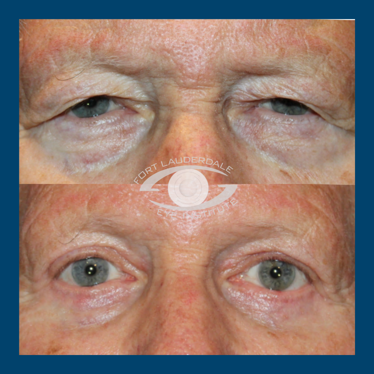 pt5 upper lower bleph