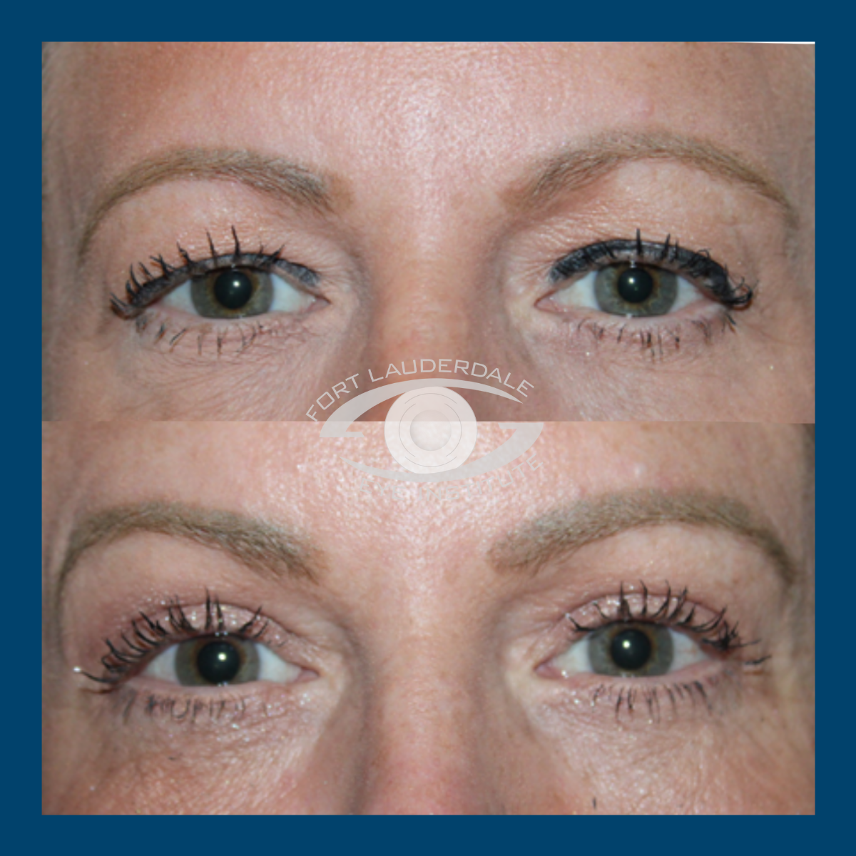 pt6 upper lower bleph